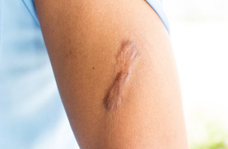 Cách trị sẹo lâu năm hiệu quả: Giải pháp cải thiện rõ rệt theo từng loại sẹo