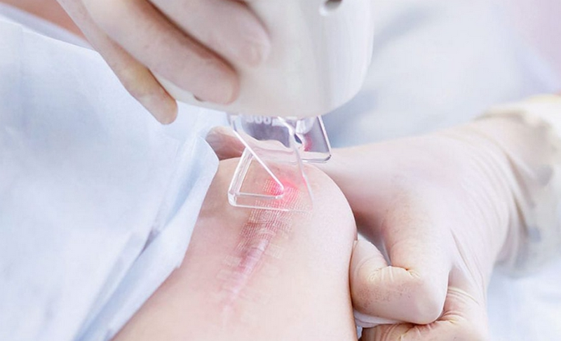 Xóa sẹo bằng laser bao nhiêu tiền? Có vĩnh viễn không? (Cập nhật 2026)