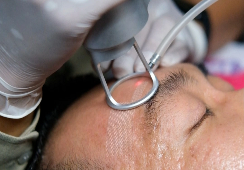Xóa sẹo bằng laser bao nhiêu tiền? Có vĩnh viễn không? (Cập nhật 2026)