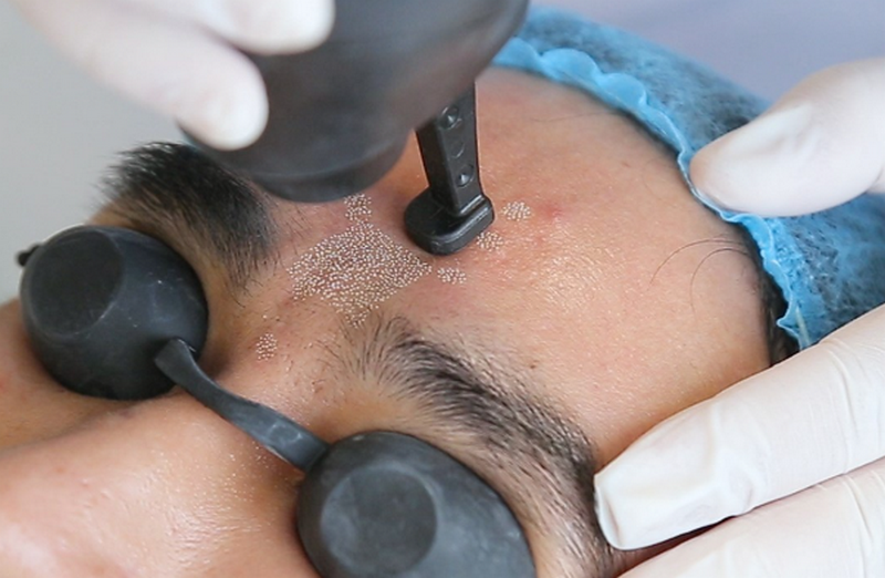 Xoá sẹo bằng laser có hết không? Ưu nhược điểm và chi phí chi tiết