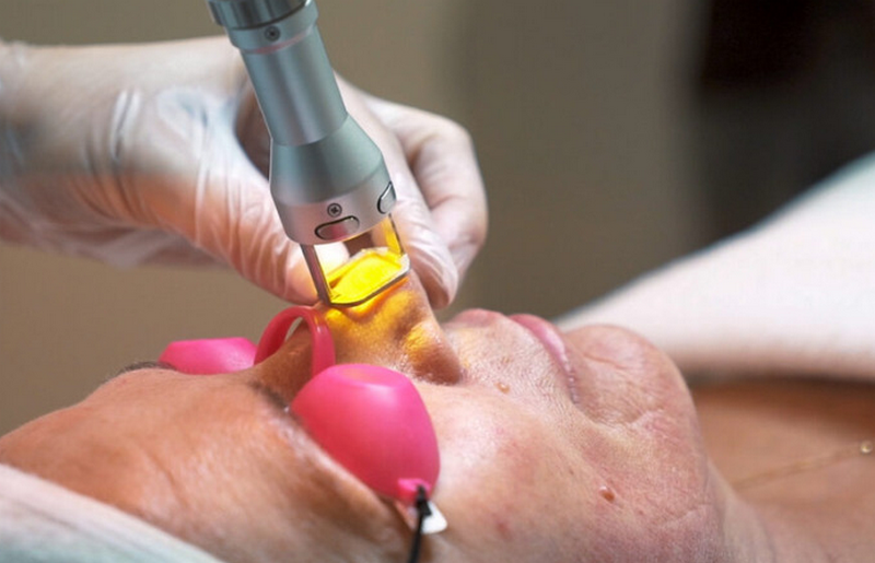 Xoá sẹo bằng laser có hiệu quả không? Ưu nhược điểm & mức độ cải thiện