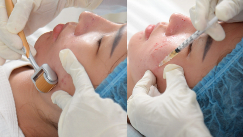 Top công nghệ xoá sẹo thẩm mỹ hiệu quả nhất (bác sĩ khuyên dùng)