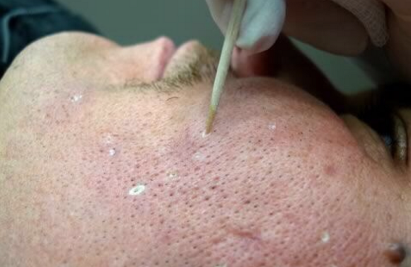 Top công nghệ xoá sẹo thẩm mỹ hiệu quả nhất hiện nay (bác sĩ khuyên dùng)