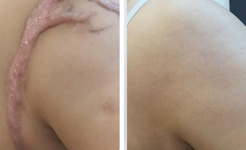 Top công nghệ xoá sẹo thẩm mỹ hiệu quả nhất hiện nay (bác sĩ khuyên dùng)