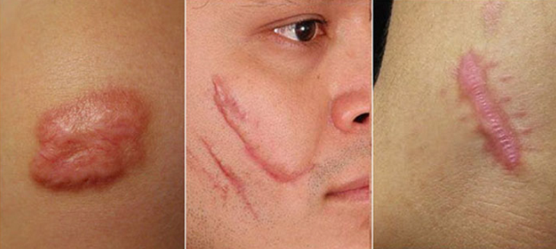 Top công nghệ xoá sẹo thẩm mỹ hiệu quả nhất hiện nay (bác sĩ khuyên dùng)