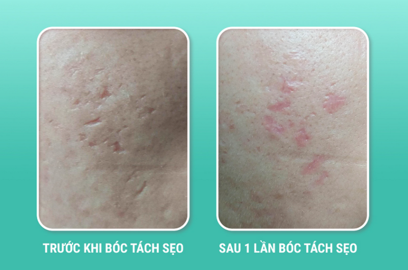 Thẩm mỹ xóa sẹo trên mặt có hiệu quả không? Giải đáp từ chuyên gia