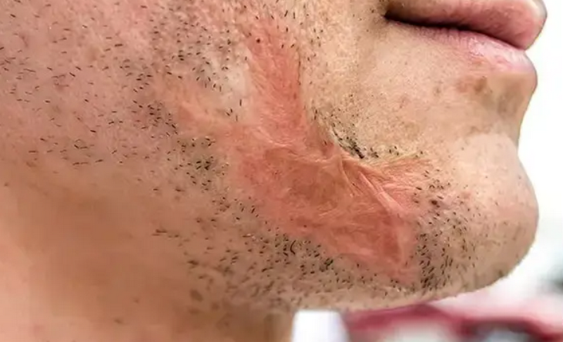 Thẩm mỹ xóa sẹo trên mặt có hiệu quả không? Giải đáp từ chuyên gia