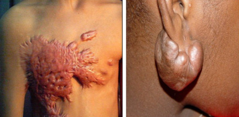 Sẹo lồi có tự hết không? Hay sẽ to hơn? Có cần điều trị không?