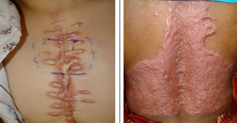 Sẹo lồi có tự hết không? Hay sẽ to hơn? Có cần điều trị không?