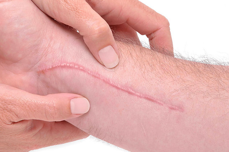 Sẹo lồi có tự hết không? Hay sẽ to hơn? Có cần điều trị không?