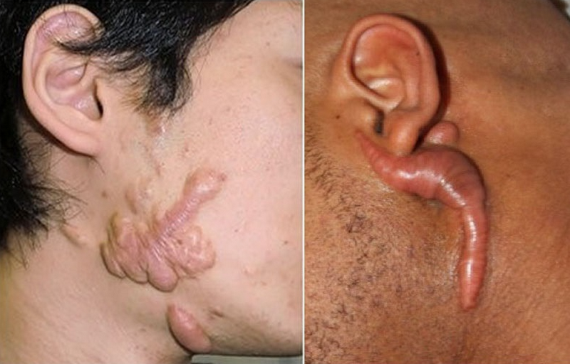 Cách trị sẹo lồi trên mặt hiệu quả cao, an toàn và những sai lầm cần tránh