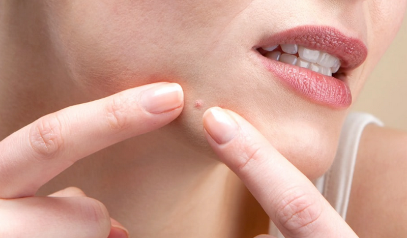 Cách trị sẹo lồi trên mặt hiệu quả cao, an toàn và những sai lầm cần tránh