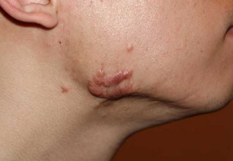 Cách trị sẹo lồi trên mặt hiệu quả cao, an toàn và những sai lầm cần tránh