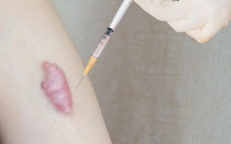 Sẹo lồi lâu năm có trị được không? Hiệu quả thực tế