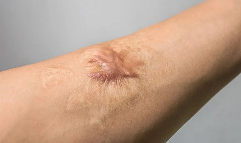 Sẹo lồi lâu năm có trị được không? Sự thật và hướng điều trị