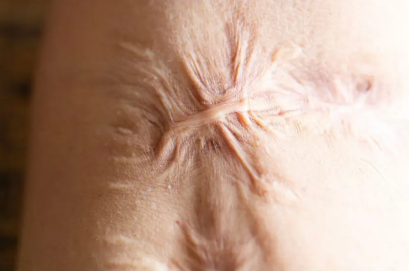 Trị sẹo lồi mới hình thành: Xử lý sớm ngăn sẹo phát triển