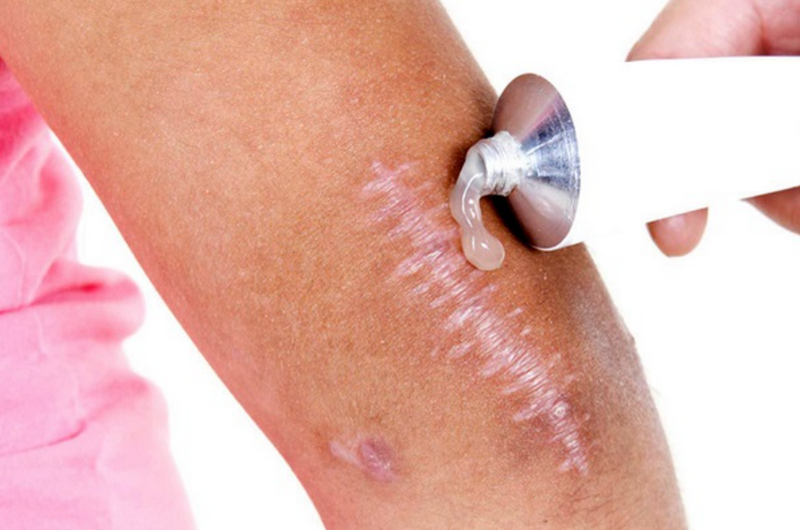 Trị sẹo lồi mới hình thành: Xử lý sớm ngăn sẹo phát triển