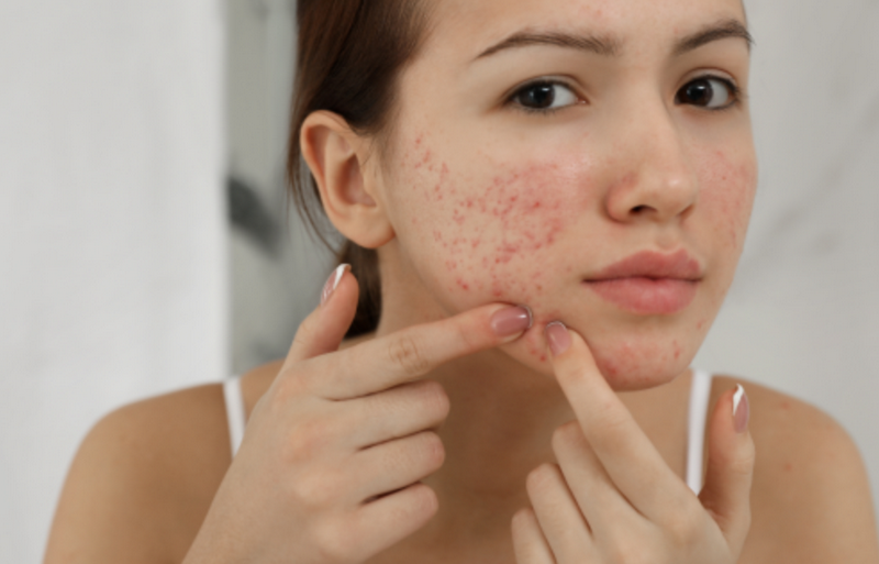 Sẹo lồi do mụn gây ra? Cách nhận biết và phương pháp điều trị