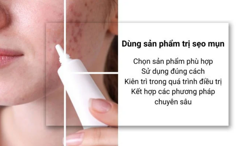 Vì sao mụn gây sẹo lồi? Cách nhận biết sẹo lồi do mụn và phương pháp điều trị