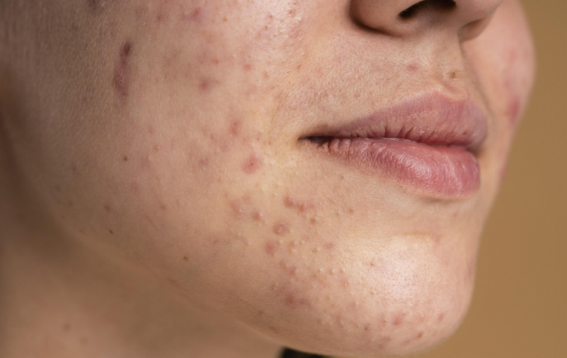 Vì sao mụn gây sẹo lồi? Cách nhận biết sẹo lồi do mụn và phương pháp điều trị