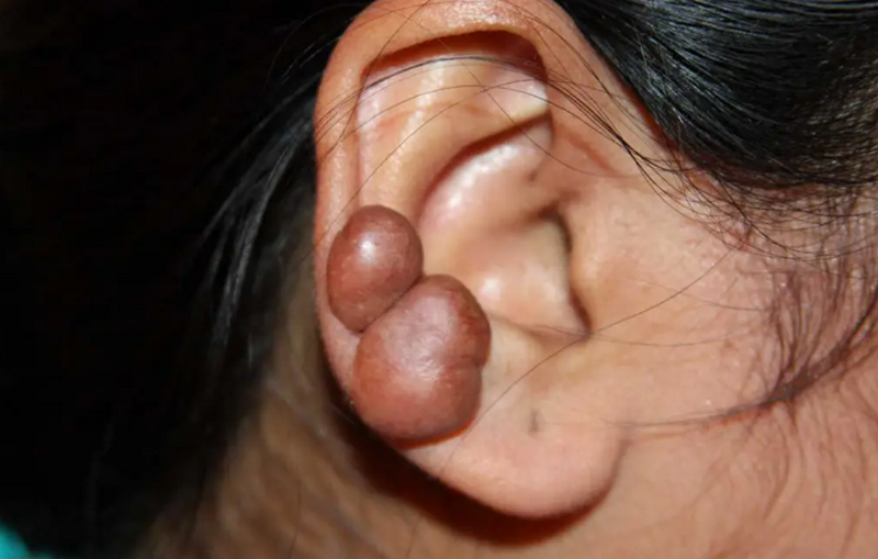 Cách trị sẹo lồi lâu năm: Phương pháp và hiệu quả thực tế