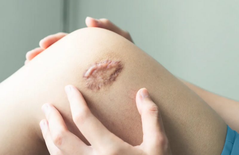 Cách trị sẹo lồi lâu năm: Phương pháp và hiệu quả cải thiện thực tế