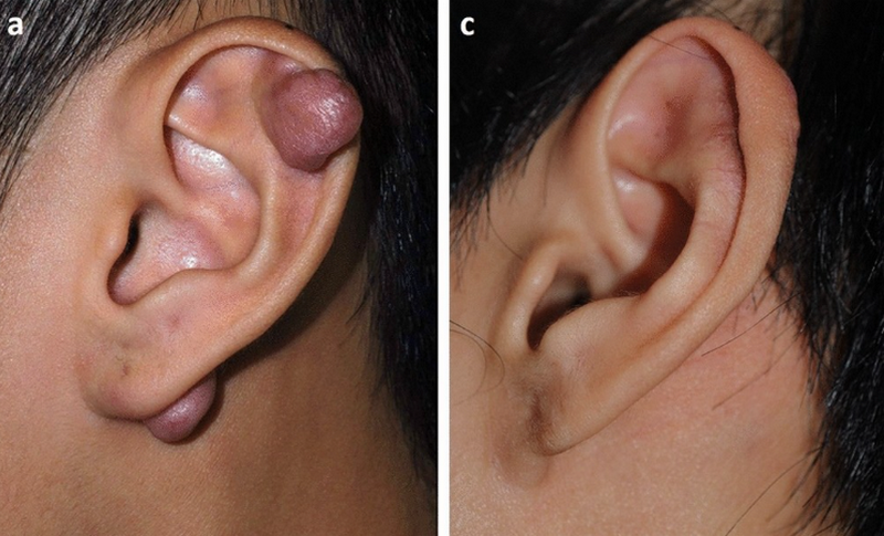 Cách trị sẹo lồi lâu năm: Phương pháp và hiệu quả thực tế