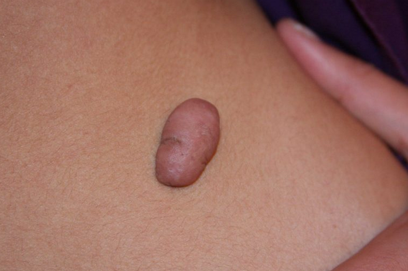 Cơ địa sẹo lồi là gì? Cách nhận biết & làm sao để tránh hình thành sẹo lồi?