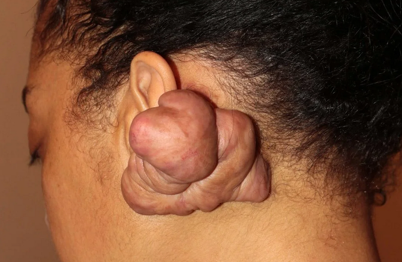 Cơ địa sẹo lồi khiến da dễ hình thành sẹo ngay cả với những tổn thương nhỏ.