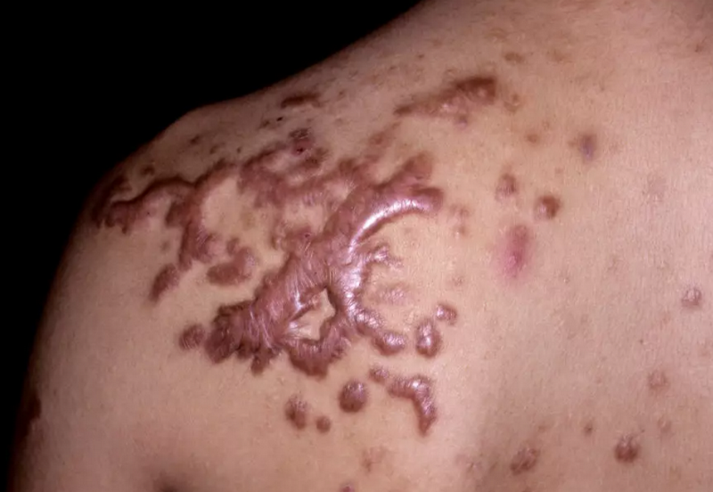 Cơ địa sẹo lồi là gì? Cách nhận biết & phòng tránh sẹo lồi?