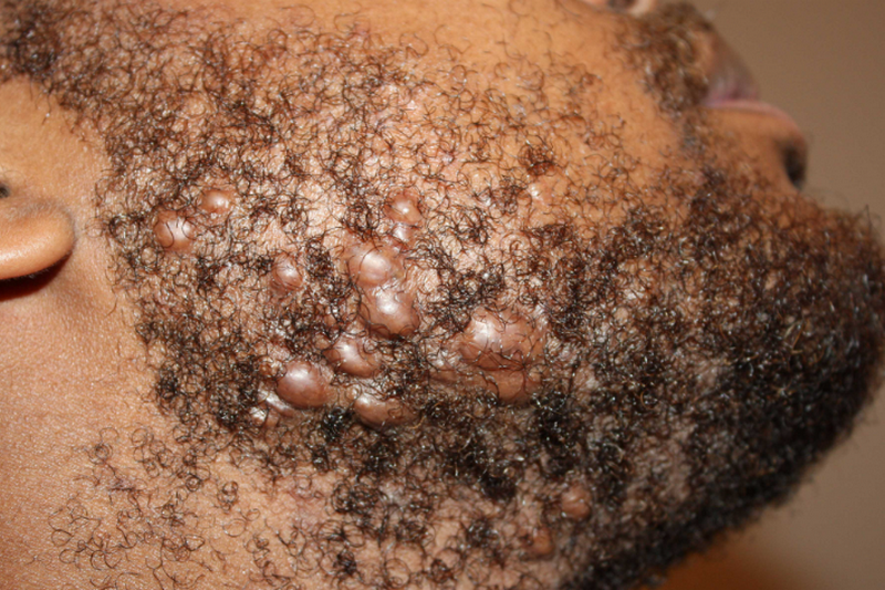 Cơ địa sẹo lồi liên quan đến sự tăng sinh collagen quá mức