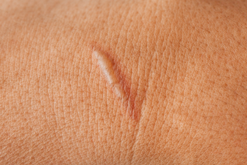 Sẹo lồi c&oacute; chữa được kh&ocirc;ng? Giải đ&aacute;p từ chuy&ecirc;n gia da liễu