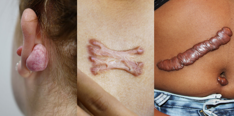 Sẹo lồi c&oacute; chữa được kh&ocirc;ng? Giải đ&aacute;p từ chuy&ecirc;n gia da liễu