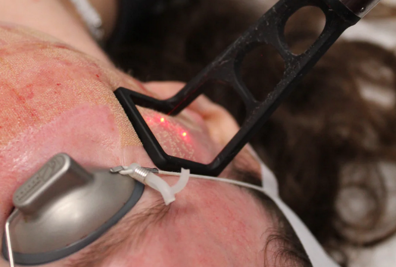 Sẹo lồi c&oacute; chữa được kh&ocirc;ng? Giải đ&aacute;p từ chuy&ecirc;n gia da liễu