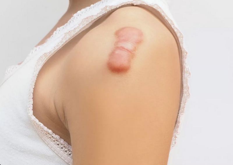 Sẹo lồi có chữa được không? Giải đáp chi tiết từ chuyên gia da liễu