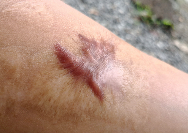 Vì sao sẹo lồi ngày càng to? Cảnh báo và cách xử lý tránh sẹo lan rộng