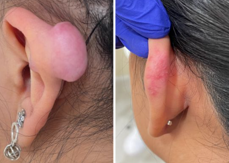 Sẹo lồi ph&aacute;t triển do collagen sản sinh qu&aacute; mức v&agrave; k&eacute;o d&agrave;i sau khi vết thương đ&atilde; l&agrave;nh.