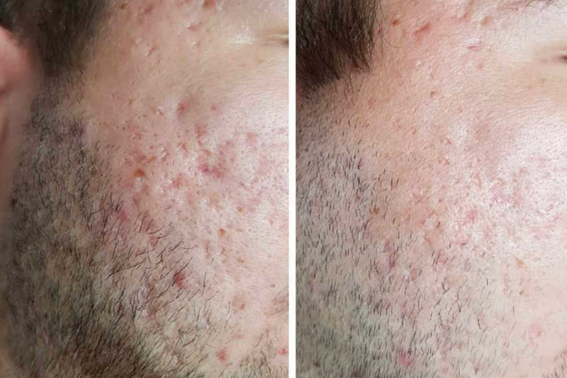 Sẹo rỗ l&agrave; g&igrave;? Nguy&ecirc;n nh&acirc;n, ph&acirc;n loại v&agrave; phương ph&aacute;p điều trị hiệu quả