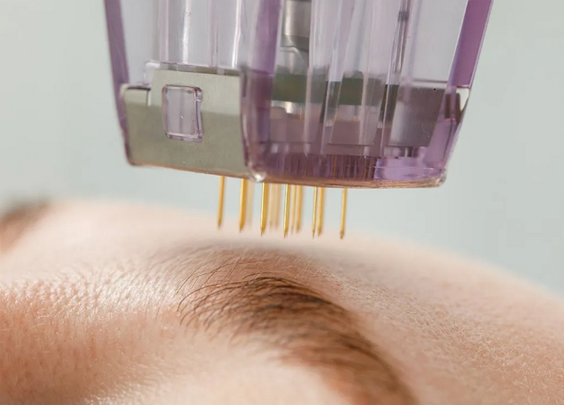 Sẹo rỗ l&agrave; g&igrave;? Nguy&ecirc;n nh&acirc;n, ph&acirc;n loại v&agrave; phương ph&aacute;p điều trị hiệu quả