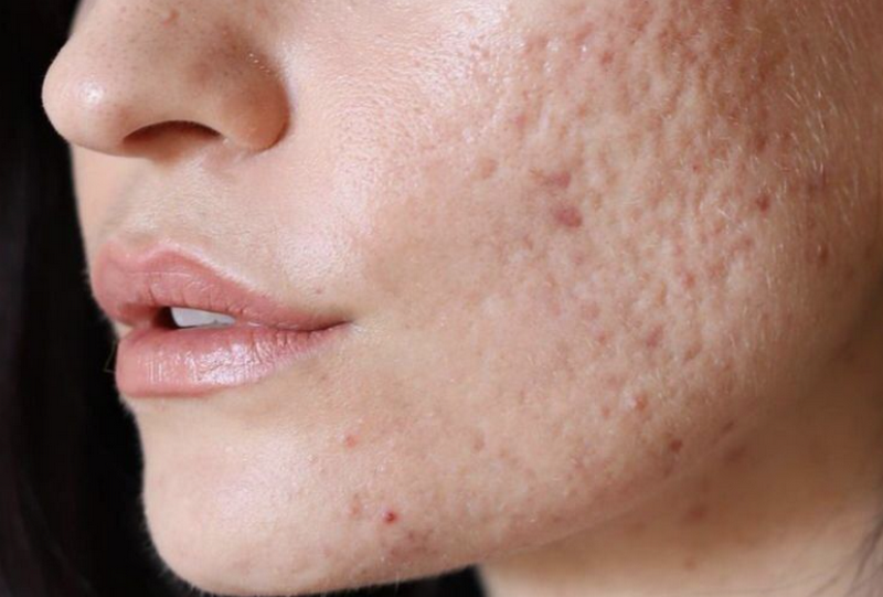 Sẹo rỗ là gì? Nguyên nhân, phân loại và phương pháp điều trị hiệu quả