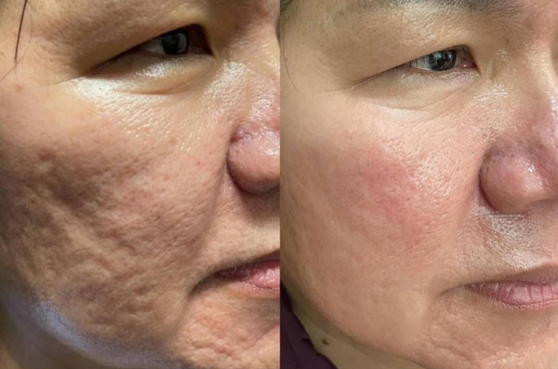 Sẹo rỗ l&agrave; g&igrave;? Nguy&ecirc;n nh&acirc;n, ph&acirc;n loại v&agrave; phương ph&aacute;p điều trị hiệu quả