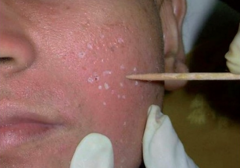 Trị sẹo rỗ c&oacute; hiệu quả kh&ocirc;ng? Phương ph&aacute;p điều trị v&agrave; mức độ cải thiện thực tế