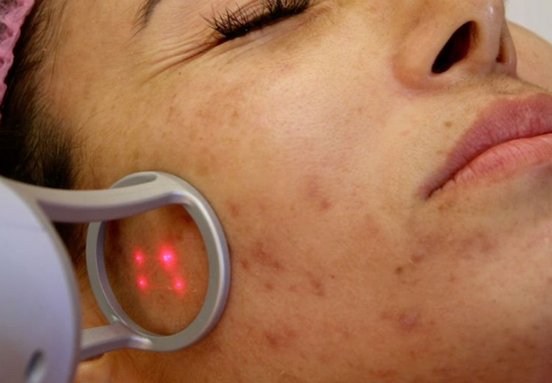 Trị sẹo rỗ c&oacute; hiệu quả kh&ocirc;ng? Phương ph&aacute;p điều trị v&agrave; mức độ cải thiện thực tế