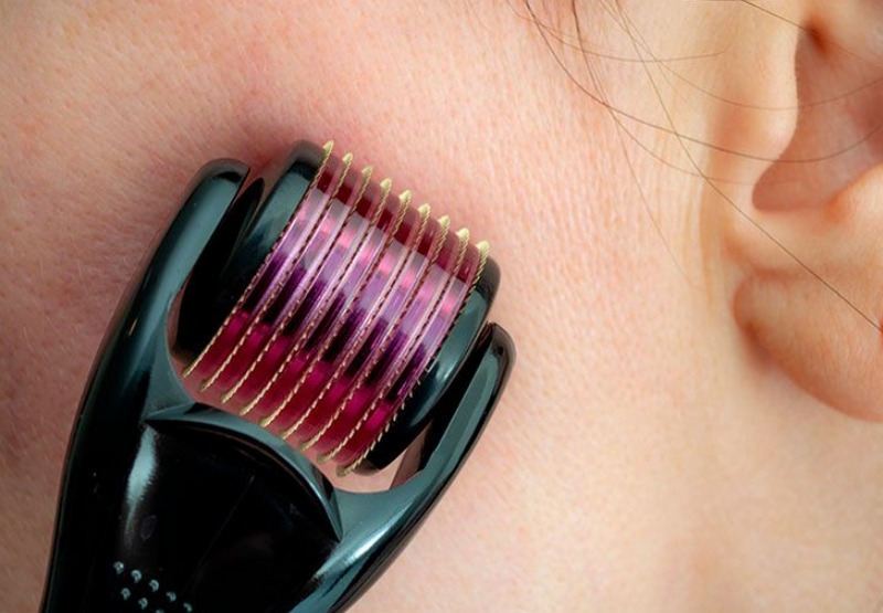 Trị sẹo rỗ c&oacute; hiệu quả kh&ocirc;ng? Phương ph&aacute;p điều trị v&agrave; mức độ cải thiện thực tế