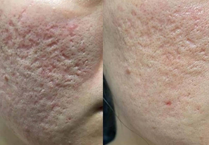 Trị sẹo rỗ c&oacute; hiệu quả kh&ocirc;ng? Phương ph&aacute;p điều trị v&agrave; mức độ cải thiện thực tế