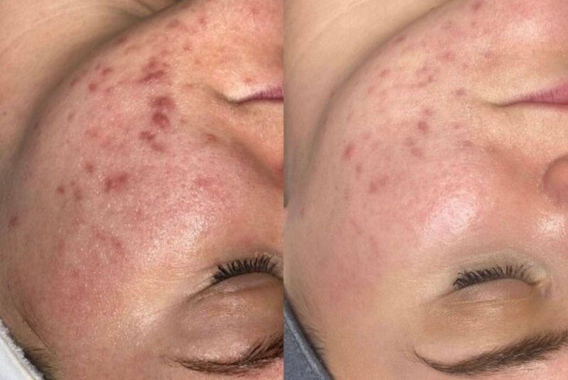 Bắn laser trị sẹo rỗ c&oacute; hiệu quả kh&ocirc;ng? Mức độ cải thiện v&agrave; rủi ro