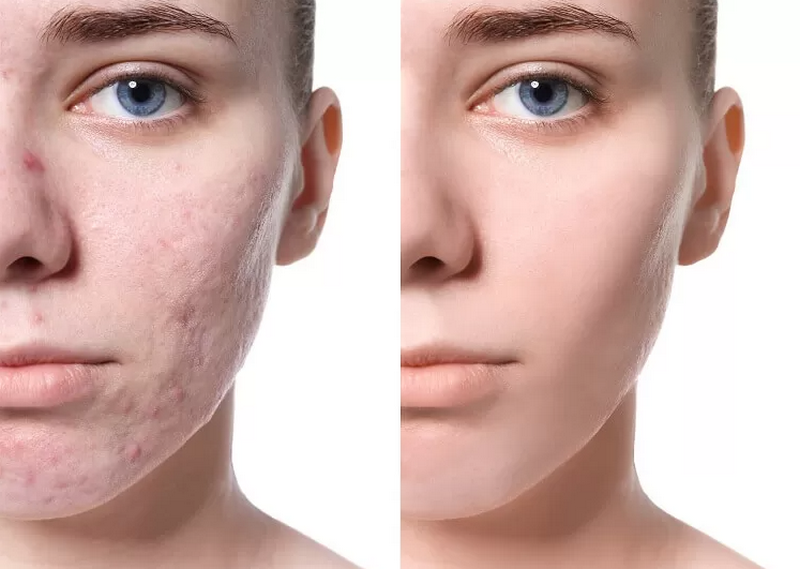 Cách trị sẹo rỗ tại nhà và hiệu quả thực tế