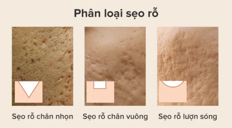 Cách trị sẹo rỗ tại nhà và hiệu quả thực tế