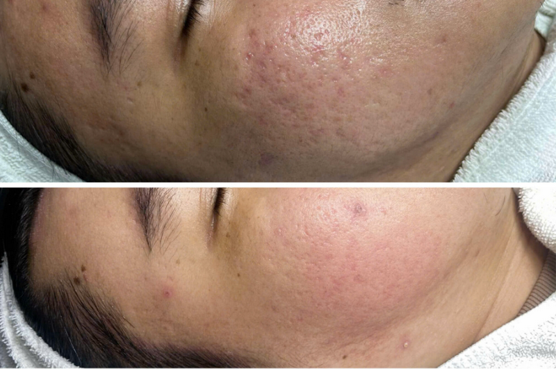 Mặt rỗ l&agrave; g&igrave;? Nguy&ecirc;n nh&acirc;n v&agrave; phương ph&aacute;p cải thiện hiệu quả