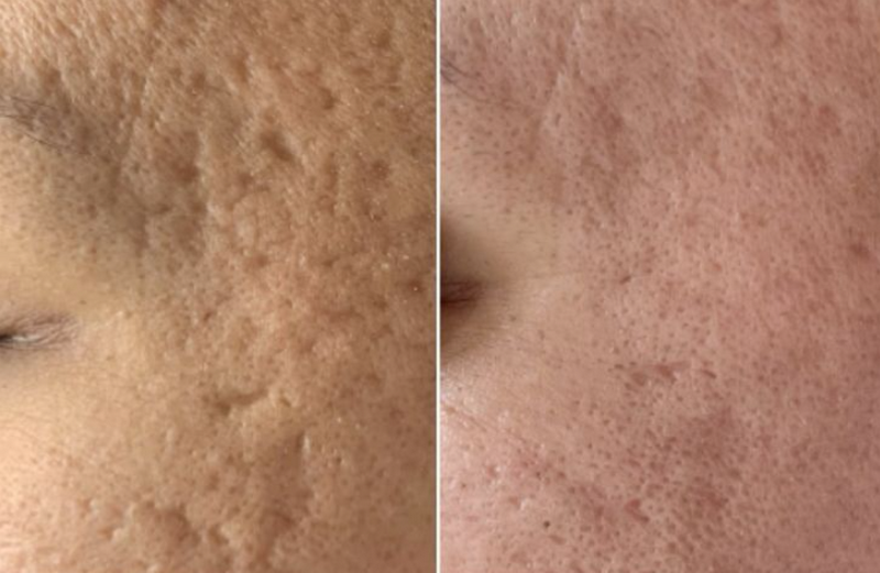 Cách trị sẹo rỗ: Các phương pháp và lựa chọn phù hợp từng loại sẹo